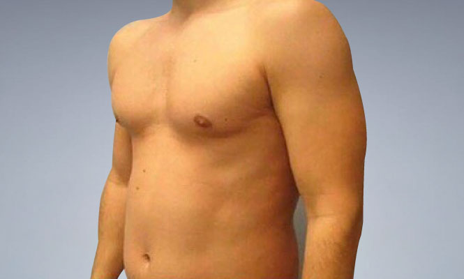 Marcación de Abdominales